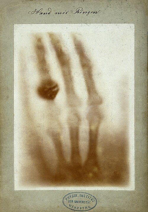 Early X-ray image showing the bones of a hand and a ring